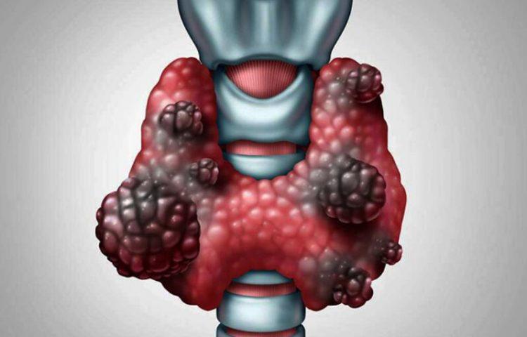 甲状腺癌的类型、分期、症状、诊断、治疗及预期寿命