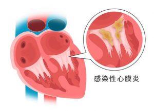 感染性心内膜炎